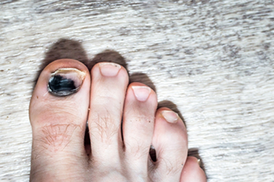 Causes And Symptoms Of Bruised Toenails